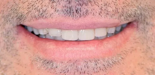 Patient's teeth after treatment