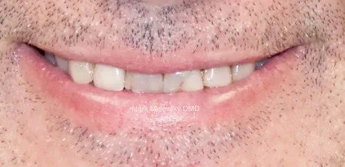 Patient's teeth before treatment