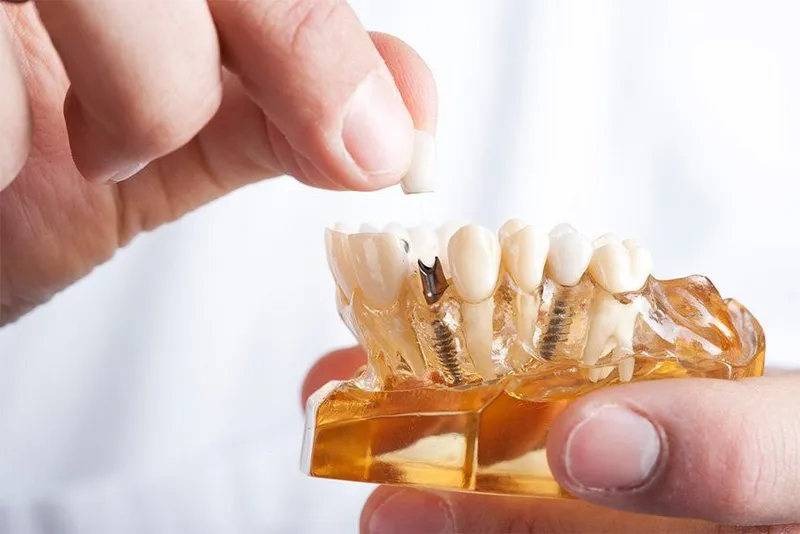 Dental implant model