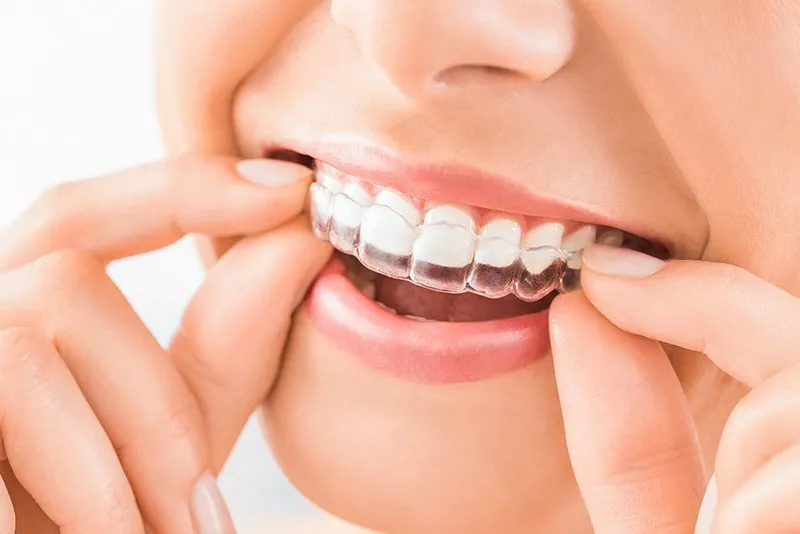 Patient placing an Invisalign aligner